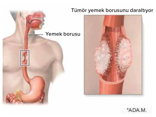 Yemek borusu ve tümörün yemek borusunu daraltması
