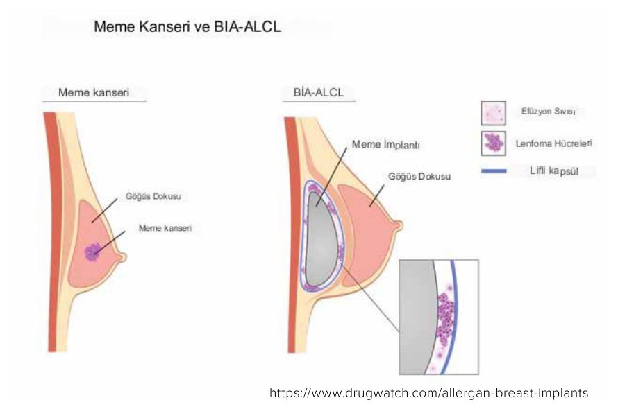 Meme kanseri ile meme implantına bağlı anaplastik büyük hücreli lenfoma (BIA-ALCL) karşılaştırması